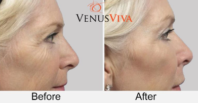 Skin Resurfacing Without Surgery: Venus Legacy vs. ExploreRF