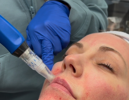 July Special: Dermalinfusion + Microneedling – The Ultimate Skin Reset for Just $269!