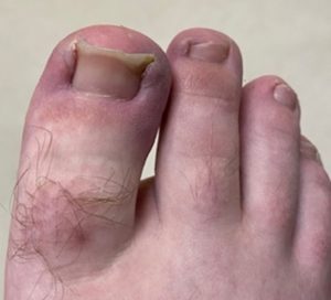 Ingrown Toenails