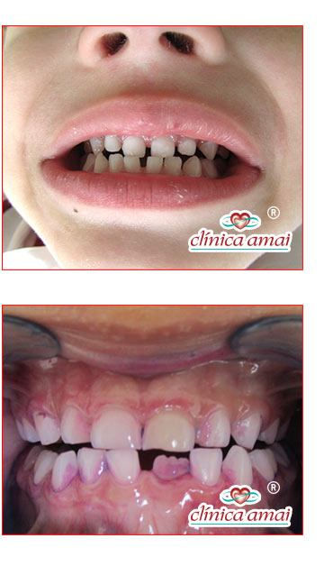 Crian a Que Range Os Dentes Quando Dorme Em Rela o Crian as