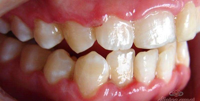 gengivite-em-acrianças.jpg