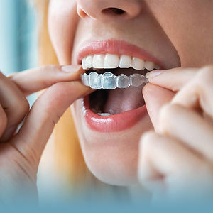 Invisalign-Mobile-Header-Template-800px.jpg
