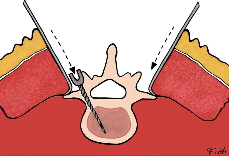 drawing of open spondylodese