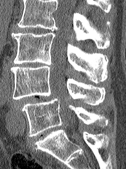 CT-Spondylisthese-L4-5