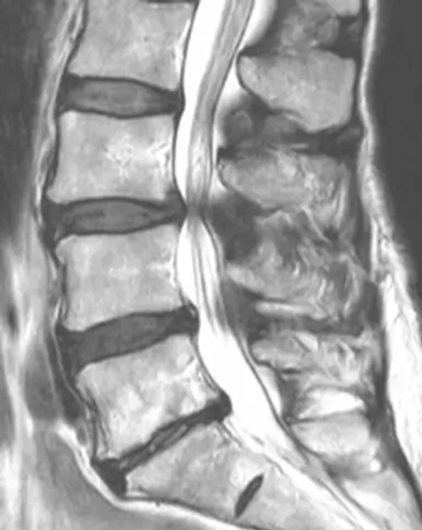 MRT der LWS mit Spinalkanalstenose