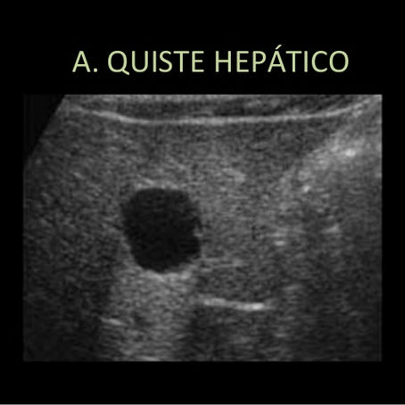 Tumores Benignos de Hígado, Trasplante hepático e Hipertensión Portal - Dra. Richards 