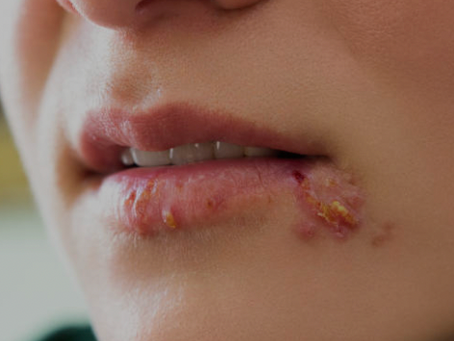 Herpafend: The Breakthrough Solution for Herpes Relief – A Permanent Cure Within Your Reach