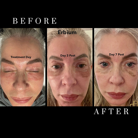 Erbium Yag Skin Resurfacing with Spectrum