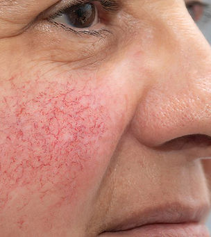 Women-Cheeks-1-min-1024x533.jpg