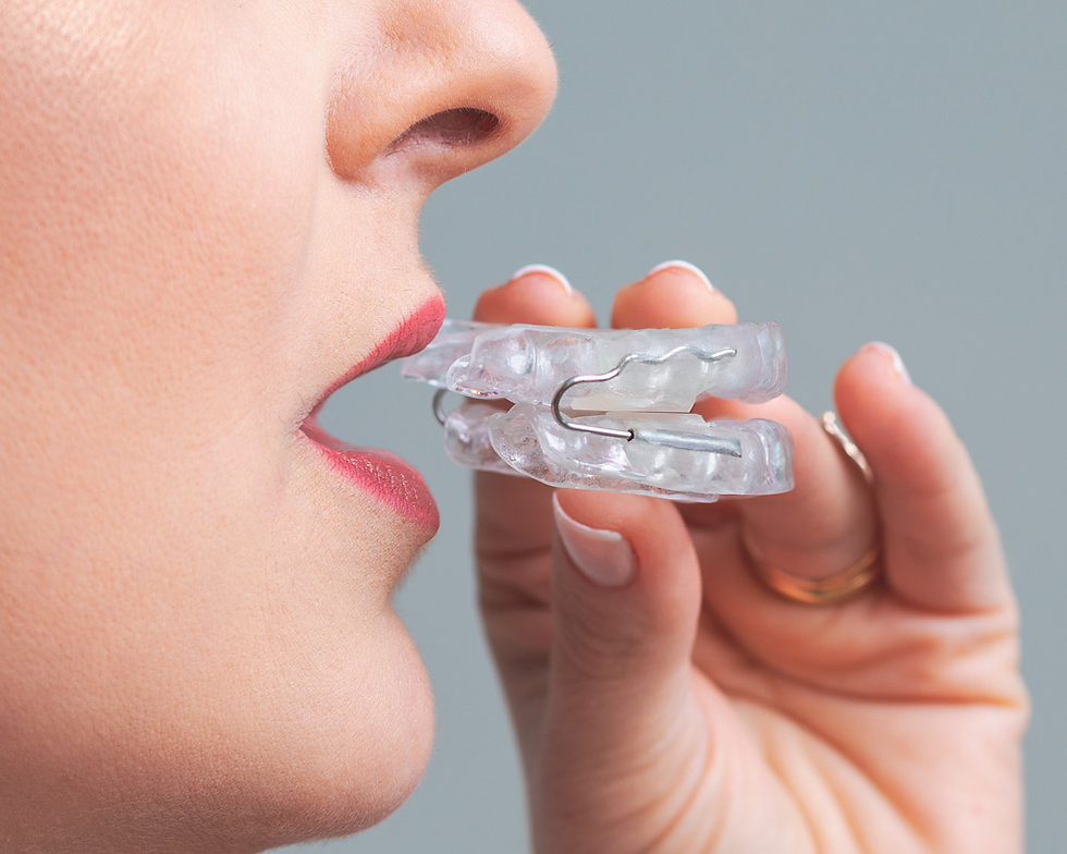 Aparelho Intraoral para Ronco