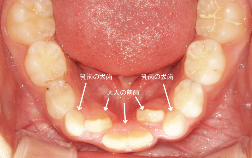 こうなると、歯並びが悪くなるサイン