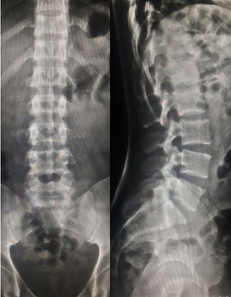 COLUMNA LUMBAR AP Y LATERAL.jpg