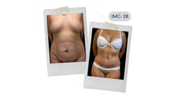 AntesDespues-Miabdominopad_Mesa de trabajo 1