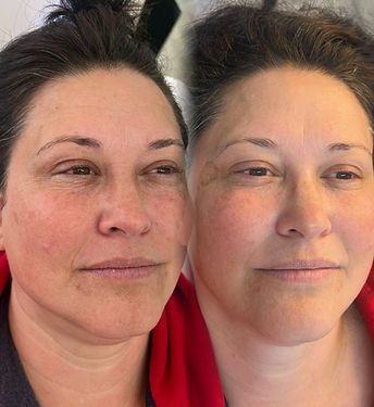 profhilo skin booster