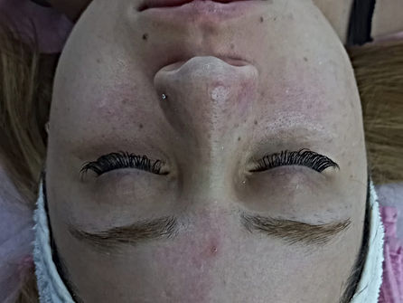  Limpieza  Facia:l retiro de puntos negros