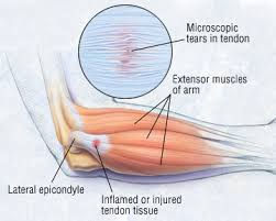 lateral epicondylitt, lateral epikondylitt, tennisalbue, musearm, golfalbue, albuesmerter