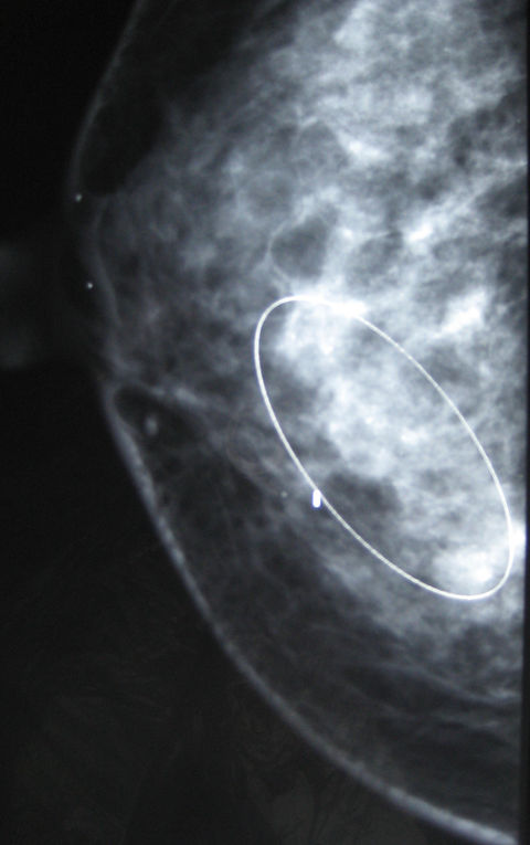 Breast cancer mammogram