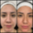 before and after of client with glowing skin