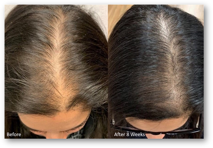 KeraLase B&A (7).png