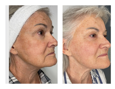 Before and after skin rejuvenation at a med spa chandler.