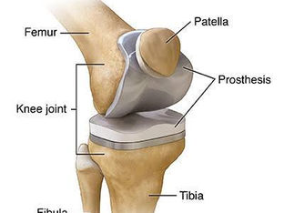 Role of Physiotherapy after Knee Replacement Surgery