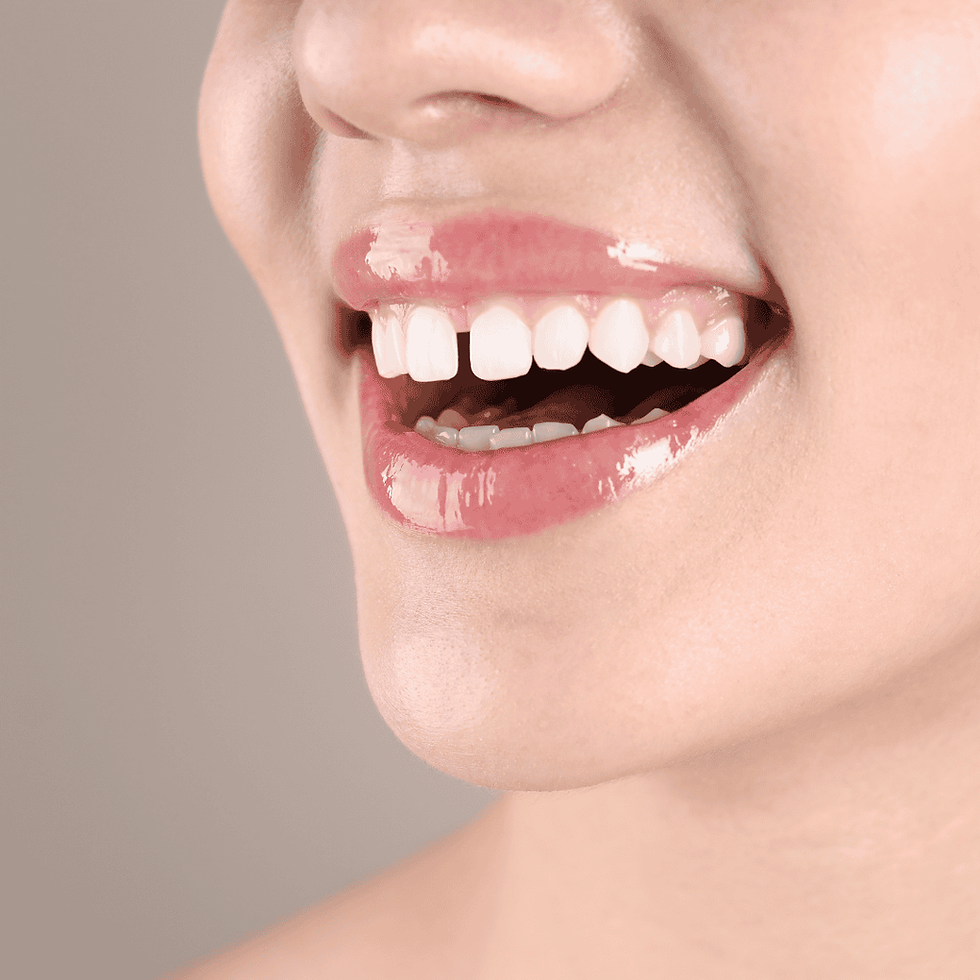 Gaps between teeth.png