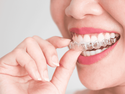 Invisalign aligners being placed on teeth