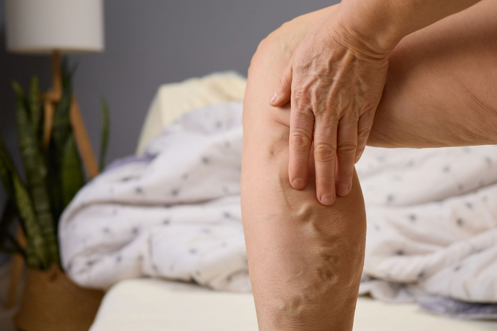 Leg showing varicose veins