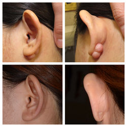 疤痕增生 耳