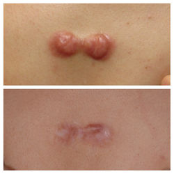 疤痕增生  冷凍治療 蟹足腫