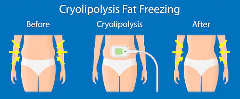 cryolipolysis coolsculpting.jpg
