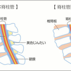 脊柱管狭窄症