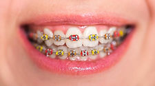 brace-color-selection-quiz.jpeg
