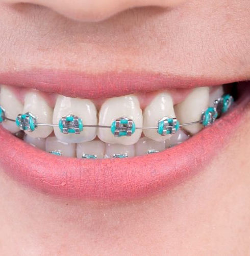 blue braces.jpeg