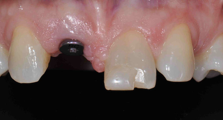 Healing-Abutment-Web.jpg