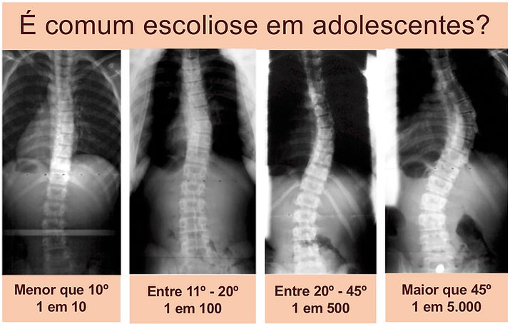 comum escoliose copy.jpg