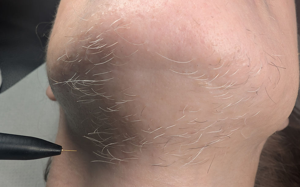 Electrolysis Permanent Facial Hair Removal: A Real Client Journey with an Award-Winning Therapist and 20 Years of Experience