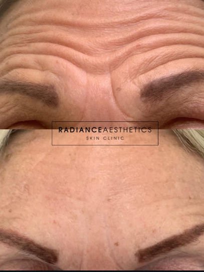 before and after of anti wrinkle injections