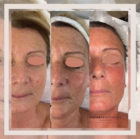 before and after picture of skinbase collagen lift radio frequency treatments