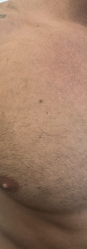 Laser Tattoo Zurich