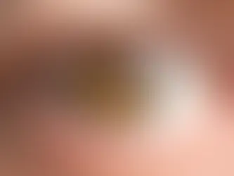 Voorbeeld oog met cataract