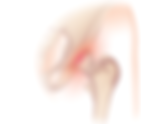 PRP Injections for Femoroacetabular Hip Impingement (FAI)