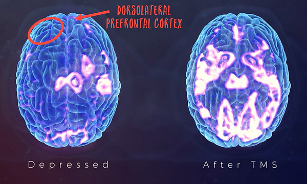 Depression affects how your Brain works