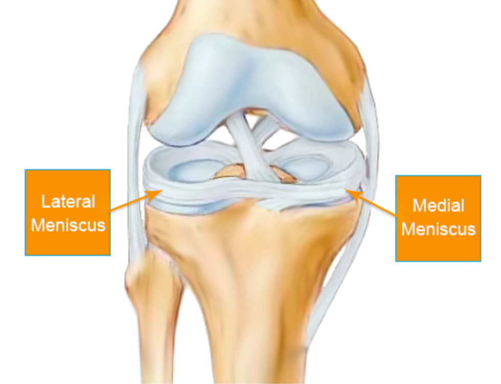 Medial meniscus posterior root tear