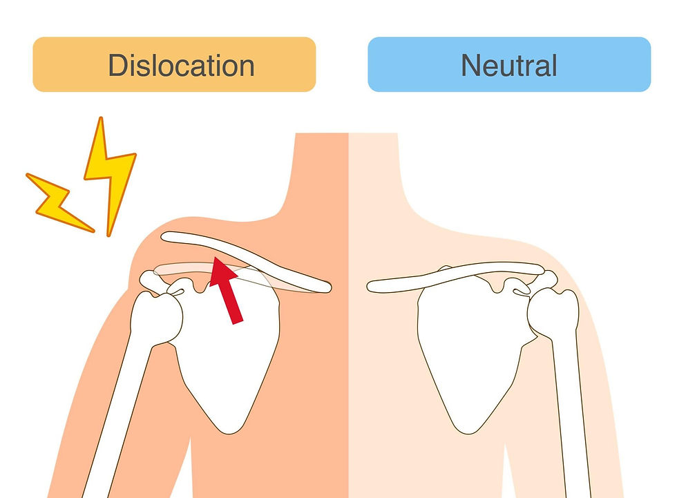 AC Joint Dislocation of Shoulder