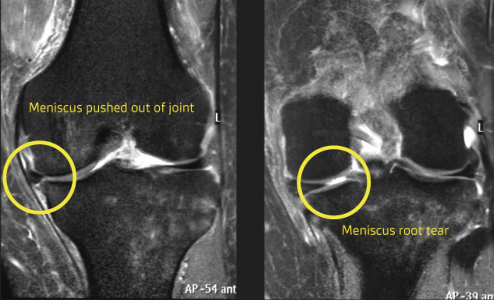 MRI showing meniscus extrusion (a) & root tear (b)