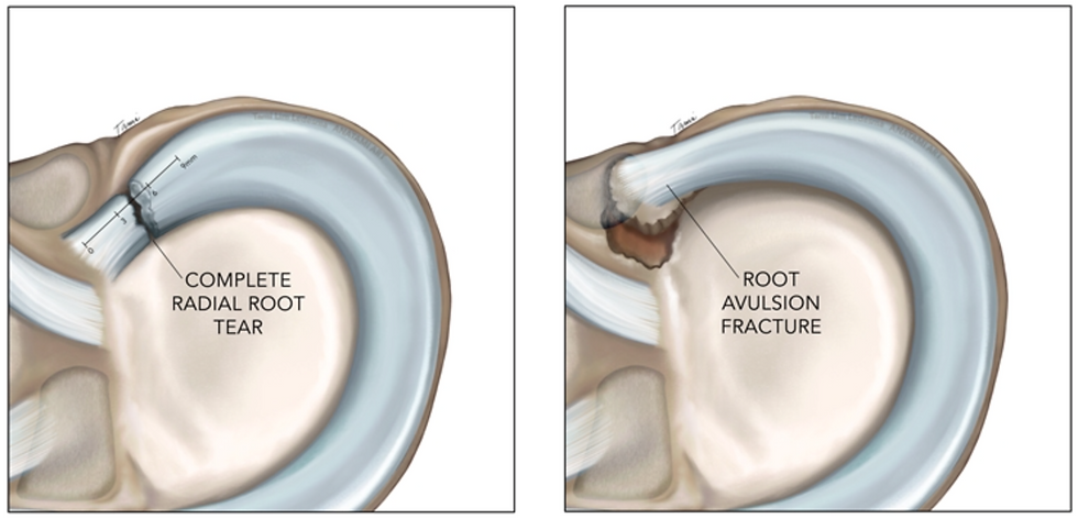 Meniscus posterior root tear (a) and its bony avulsion (b)