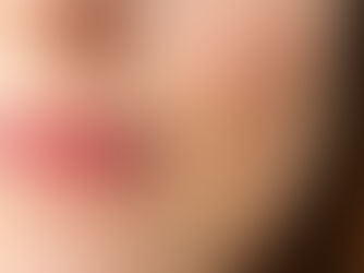 Unlocking Smoother Skin: How Microneedling Can Help with Acne Scars and Skin Texture