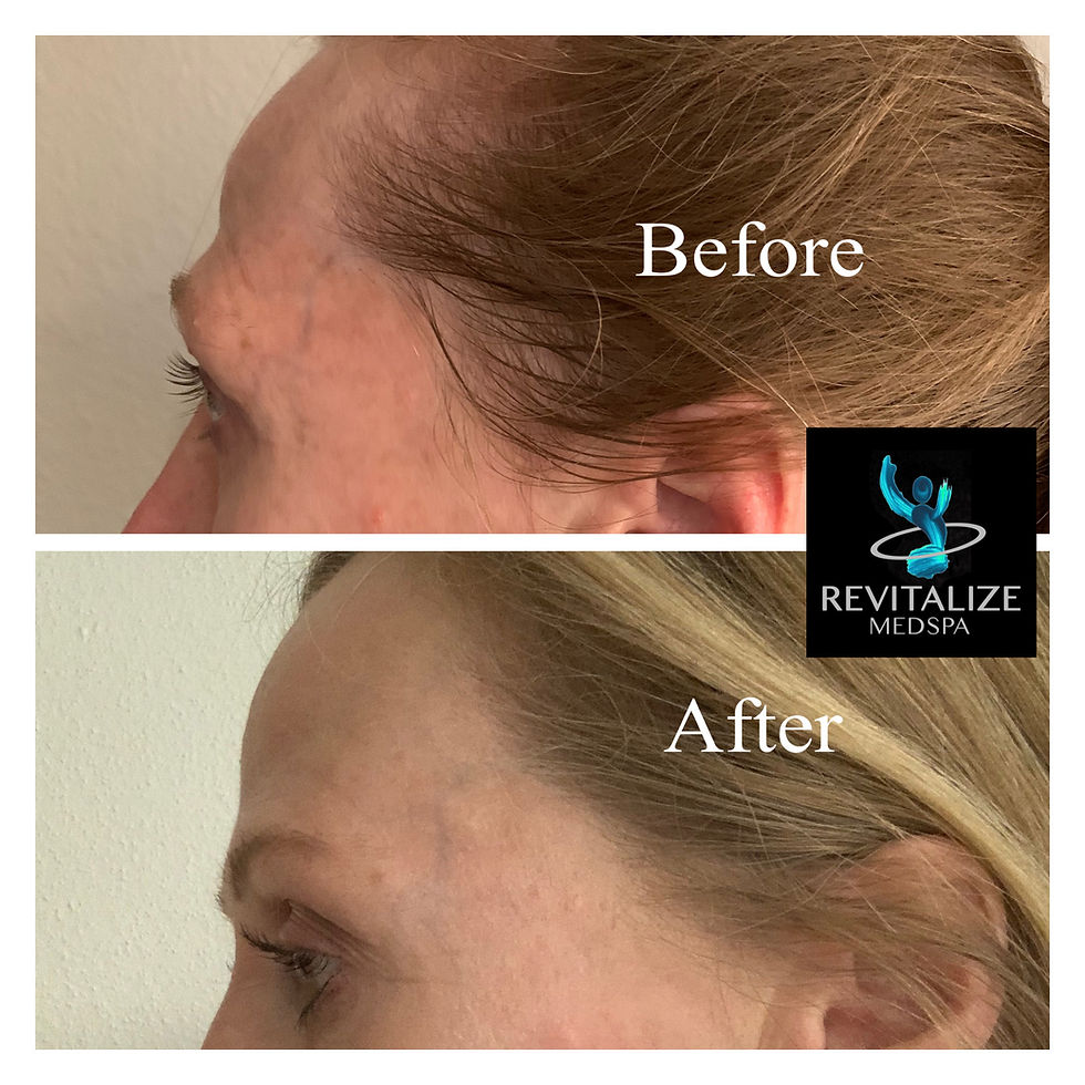 Sculptra.jpg