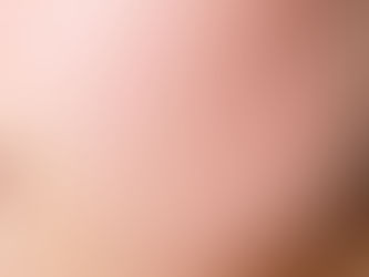 How to Fade Acne Scars with Laser Treatments: A Comprehensive Guide